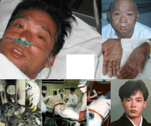 The Tragic Story Behind Hisashi Ouchi Photos: A Nuclear Accident Survivor